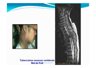Tuberculose osseuse vertébrale
Mal de PottMouffok N- VIH/SIDA Cours nov 2013
 