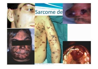 Sarcome de Kaposi
Mouffok N- VIH/SIDA Cours nov 2013
 