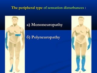 The peripheral typeThe peripheral type of sensation disturbancesof sensation disturbances ::
а)а) MononeuropathyMononeuropathy
б)б) PolyneuropathyPolyneuropathy
 