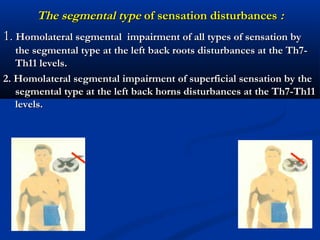 The segmental typeThe segmental type of sensation disturbancesof sensation disturbances ::
11.. Homolateral segmental impairment of all types of sensation byHomolateral segmental impairment of all types of sensation by
the segmental type at the left back roots disturbances at the Th7-the segmental type at the left back roots disturbances at the Th7-
Th11 levels.Th11 levels.
2. Homolateral segmental impairment of superficial sensation by the2. Homolateral segmental impairment of superficial sensation by the
segmental type at the left back horns disturbances at the Th7-Th11segmental type at the left back horns disturbances at the Th7-Th11
levels.levels.
 