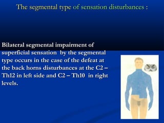 The segmental typeThe segmental type of sensation disturbancesof sensation disturbances ::
Bilateral segmental impairment ofBilateral segmental impairment of
superficial sensation by the segmentalsuperficial sensation by the segmental
type occurs in the case of the defeat attype occurs in the case of the defeat at
the back horns disturbances at the C2 –the back horns disturbances at the C2 –
Th12 in left side and C2 – Th10Th12 in left side and C2 – Th10 in rightin right
levels.levels.
 