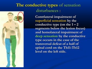 The conductive typesThe conductive types of sensationof sensation
disturbancesdisturbances ::
Contrlateral impairment ofContrlateral impairment of
superficial sensationsuperficial sensation by theby the
conductive type (on the 1 – 2conductive type (on the 1 – 2
segments below the lesion focus)segments below the lesion focus)
and homolateral impairment ofand homolateral impairment of
deep sensationdeep sensation by the conductiveby the conductive
type occurs in the case of thetype occurs in the case of the
transversal defeat of a half oftransversal defeat of a half of
spinal cord on the Th11-Th12spinal cord on the Th11-Th12
level on the left side.level on the left side.
 