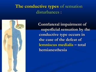 The conductive typesThe conductive types of sensationof sensation
disturbancesdisturbances ::
Contrlateral impairment ofContrlateral impairment of
superficial sensation by thesuperficial sensation by the
conductive type occurs inconductive type occurs in
the case of the defeat ofthe case of the defeat of
lemniscus medialislemniscus medialis – total– total
hemianesthesiahemianesthesia
 