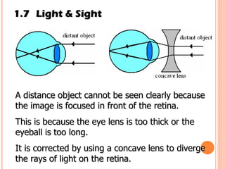 1.7 Light & Sight A distance object cannot be seen clearly because the image is focused in front of the retina. This is because the eye lens is too thick or the eyeball is too long. It is corrected by using a concave lens to diverge the rays of light on the retina. 