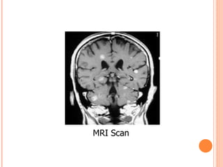 MRI Scan  