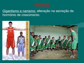 HIPÓFISE
Gigantismo e nanismo: alteração na secreção de
hormônio de crescimento.
 