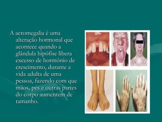 A acromegalia é umaA acromegalia é uma
alteração hormonal quealteração hormonal que
acontece quando aacontece quando a
glândula hipófise liberaglândula hipófise libera
excesso de hormônio deexcesso de hormônio de
crescimento, durante acrescimento, durante a
vida adulta de umavida adulta de uma
pessoa, fazendo com quepessoa, fazendo com que
mãos, pés e outras partesmãos, pés e outras partes
do corpo aumentem dedo corpo aumentem de
tamanho.tamanho.
 