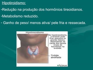 Hipotiroidismo:
-Redução na produção dos hormônios tireoidianos.
-Metabolismo reduzido.
- Ganho de peso/ menos ativa/ pele fria e ressecada.
 