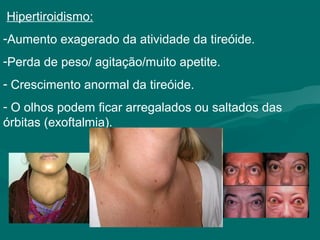 Hipertiroidismo:
-Aumento exagerado da atividade da tireóide.
-Perda de peso/ agitação/muito apetite.
- Crescimento anormal da tireóide.
- O olhos podem ficar arregalados ou saltados das
órbitas (exoftalmia).
 