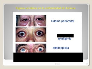 Edema periorbital
Proptosis
exoftalmia
Signos oculares en la enfermedad de Graves
oftalmoplejia
Crecimiento de lo músculos extraoculares dentro de la órbita
Los músculos se edematizan, se acumulan fibroblastos,
infiltración del infocitos
27/08/13 38
 