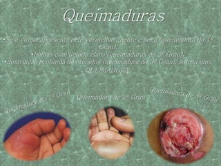 Queimaduras
•Se a vítima apresenta pele vermelha, quente e seca (queimadura do 1º
                                Grau).
         •bolhas com liquido claro (queimaduras do 2º Grau);
•destruição profunda dos tecidos (queimadura do 3º Grau), sofreu uma
                           QUEIMADURA.



                        Queimadura de 2º Grau
 