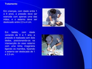 Em crianças, com idade entre 1
a 8 anos, a pressão deve ser
exercida com apenas uma das
mãos, e o esterno deve ser
deslocado entre 2,5 a 4 cm.
Tratamento
Em bebês, com idade
variando de 0 a 1 ano, a
pressão é realizada com dois
dedos, posicionando-os na
intersecção do osso esterno
com uma linha imaginária
ligando os mamilos, fazendo
o esterno ser deslocado de 1
a 2,5 cm.
 