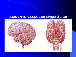 ACIDENTE VASCULAR ENCEFÁLICO
 