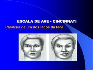 ESCALA DE AVE - CINCINNATI
Paralisia de um dos lados da face.
 