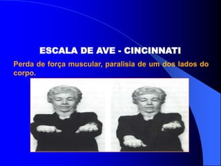 ESCALA DE AVE - CINCINNATI
Perda de força muscular, paralisia de um dos lados do
corpo.
 