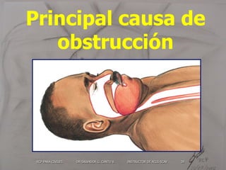 RCP PARA CIVILES DR SALVADOR G. CANTU V. INSTRUCTOR DE ACLS SCAV 39
Principal causa de
obstrucción
 