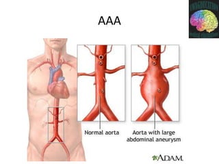 Abdominal Aortic Aneurysms | PPTX