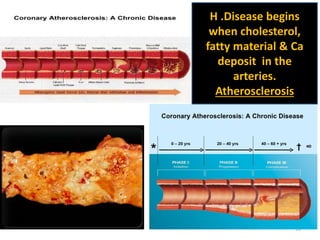 16
H .Disease begins
when cholesterol,
fatty material & Ca
deposit in the
arteries.
Atherosclerosis
 