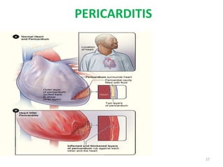 PERICARDITIS
27
 