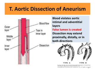 T. Aortic Dissection of Aneurism
Blood violates aortic
intimal and adventitial
layers
False lumen is created
Dissection may extend
proximally, distally, or in
both directions
30
 