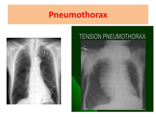 Pneumothorax
7
 