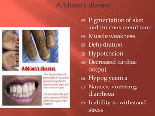  Pigmentation of skin
and mucous membrane
 Muscle weakness
 Dehydration
 Hypotension
 Decreased cardiac
output
 Hypoglycemia
 Nausea, vomiting,
diarrhoea
 Inability to withstand
stress
Addison's disease
 