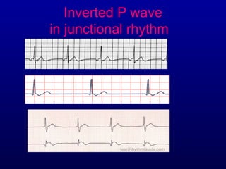 Partially Inverted P Wave 1st part ecg basics indroduction and p waves | PPT