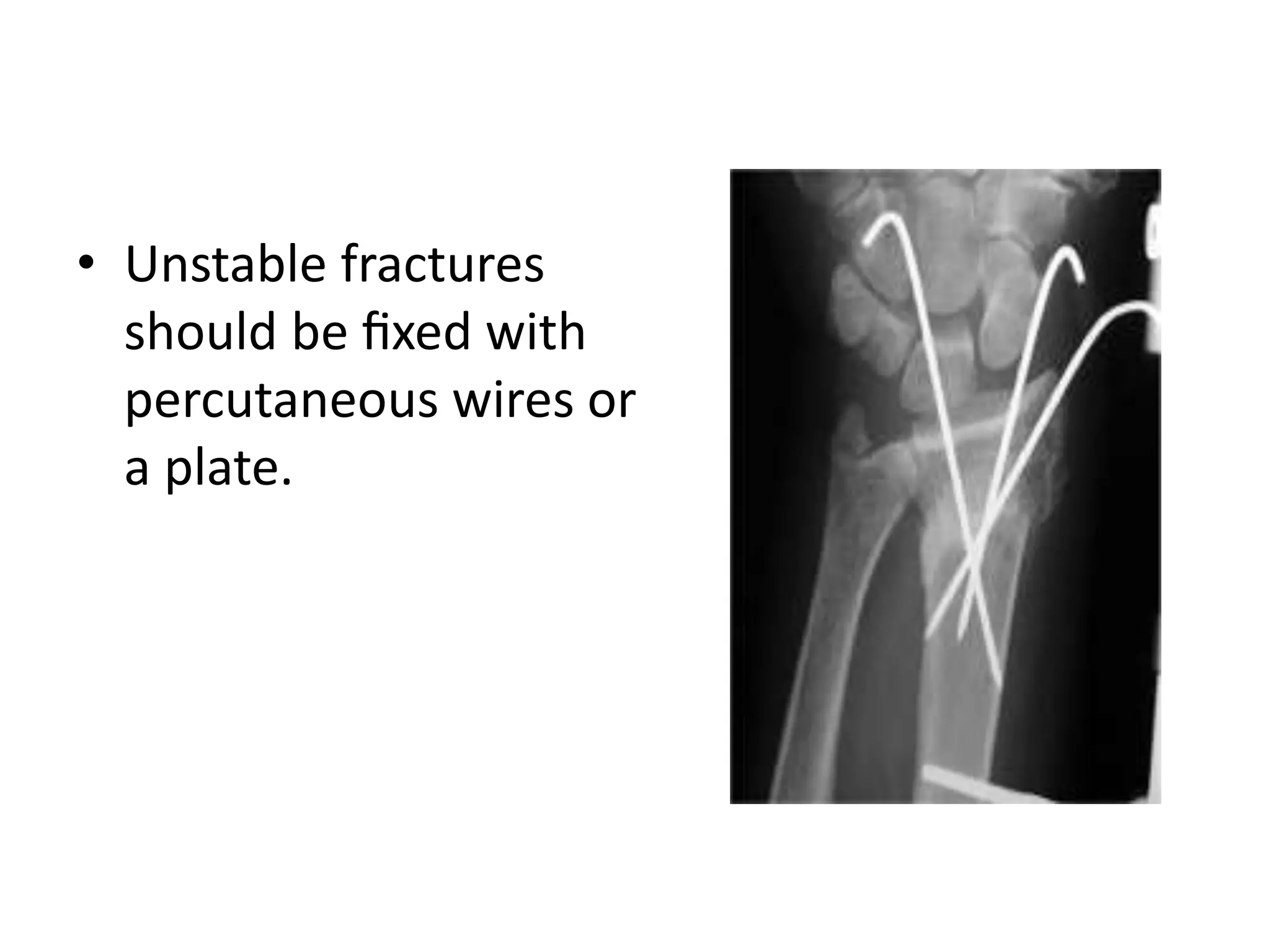 • Unstable fractures
should be fixed with
percutaneous wires or
a plate.
