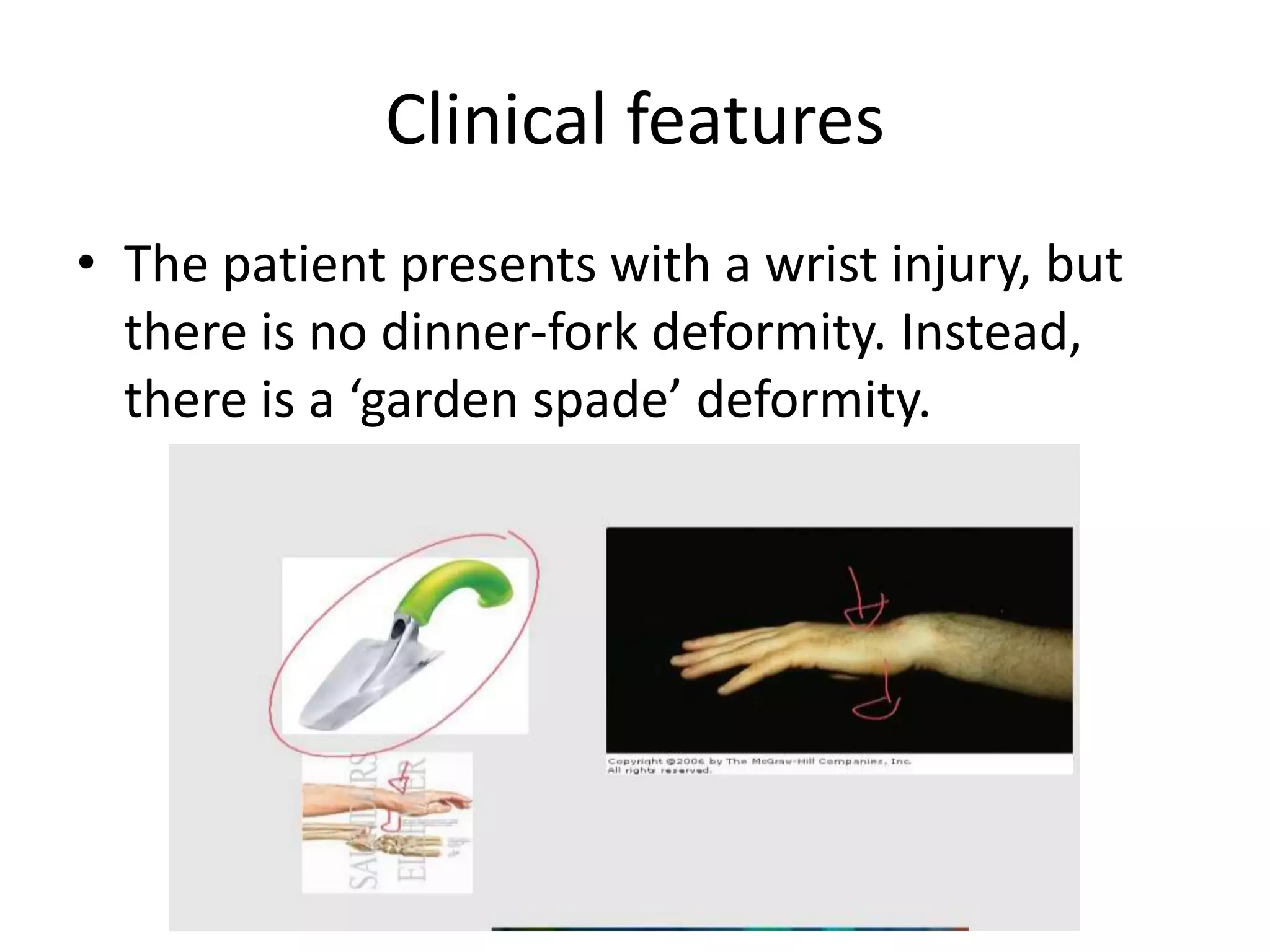 Clinical features
• The patient presents with a wrist injury, but
there is no dinner-fork deformity. Instead,
there is a ‘garden spade’ deformity.