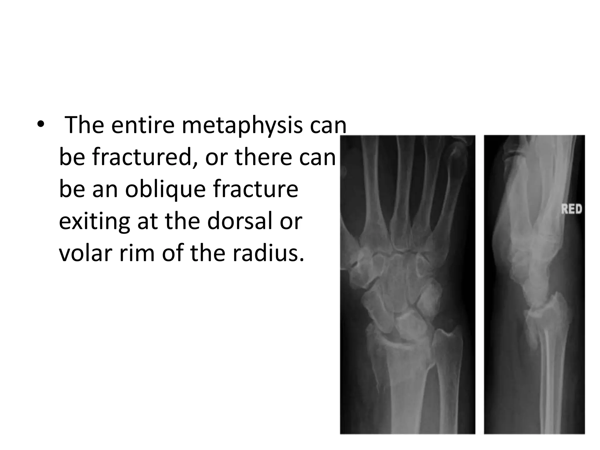 • The entire metaphysis can
be fractured, or there can
be an oblique fracture
exiting at the dorsal or
volar rim of the radius.