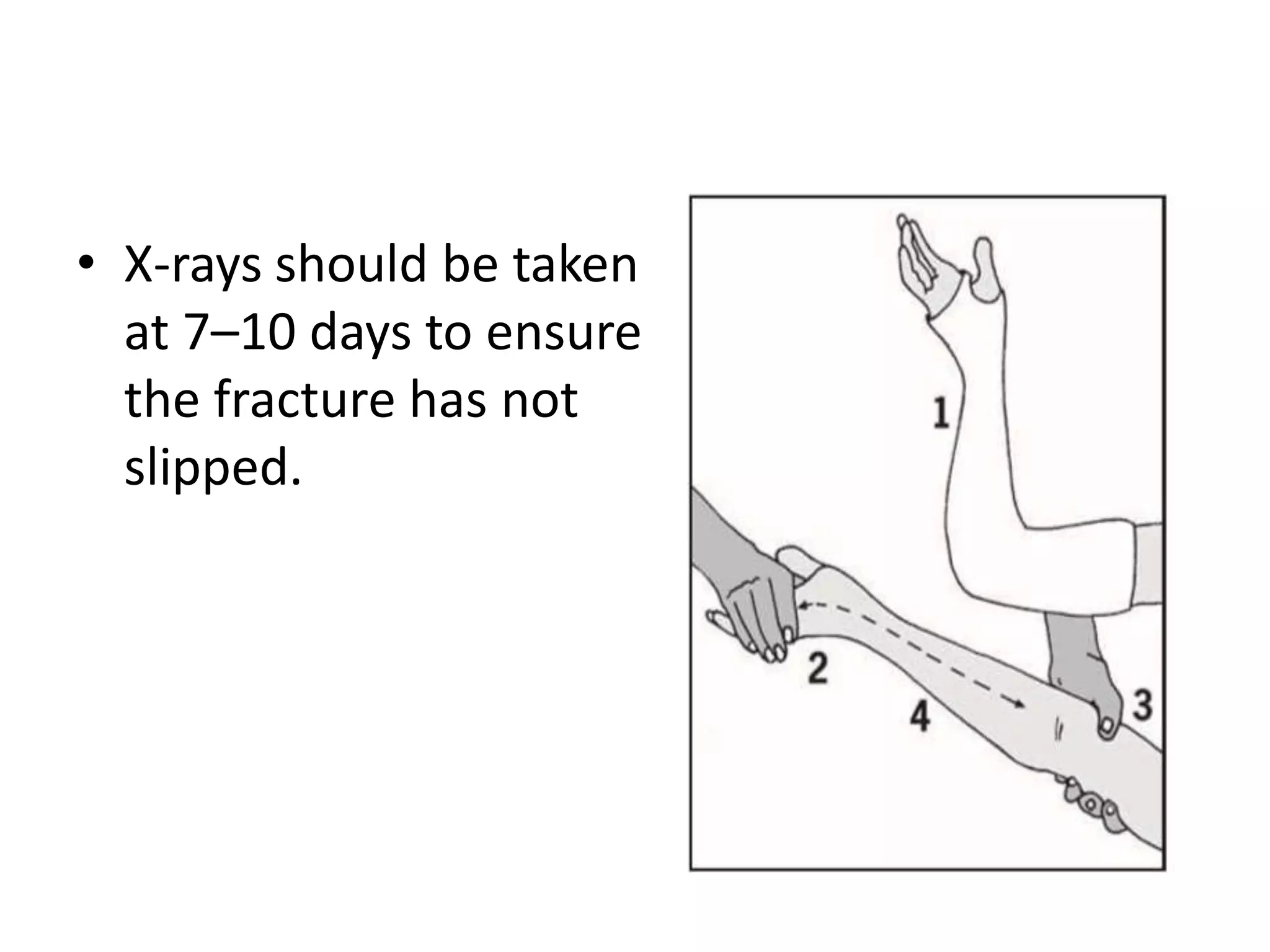 • X-rays should be taken
at 7–10 days to ensure
the fracture has not
slipped.