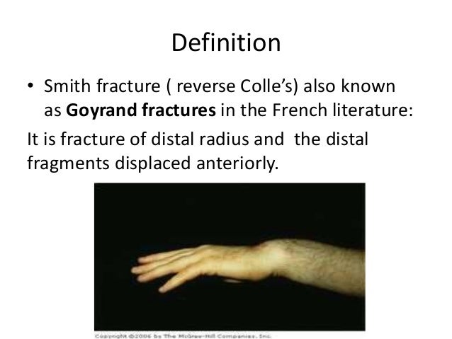 Smith Fractures