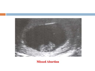 Missed Abortion
 