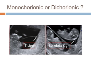 Monochorionic or Dichorionic ?
 