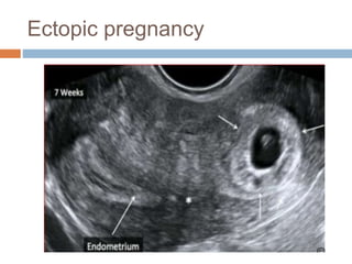 Ectopic pregnancy
 