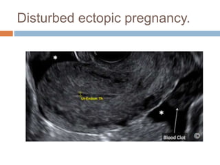 Disturbed ectopic pregnancy.
 