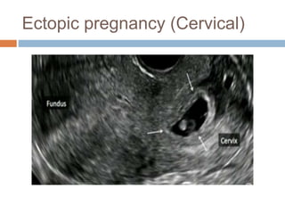 Ectopic pregnancy (Cervical)
 