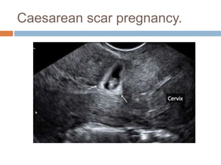 Caesarean scar pregnancy.
 