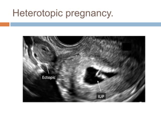 Heterotopic pregnancy.
 
