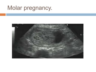 Molar pregnancy.
 