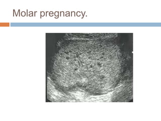 Molar pregnancy.
 