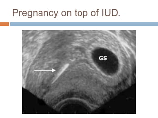 Pregnancy on top of IUD.
 