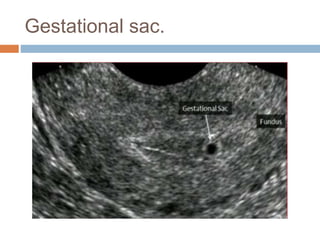 Gestational sac.
 