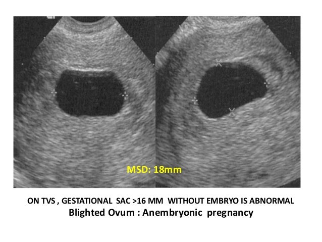 Image result for blighted ovum ultrasound msd 25