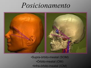 Posicionamento




  •Supra-órbito-meatal (SOM)
      •Órbito-meatal (OM)
   •Infra-órbito-meatal (IOM)
 