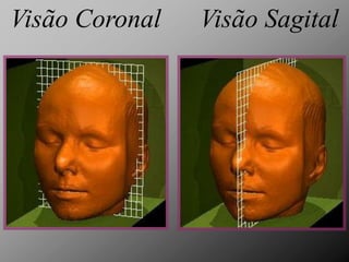 Visão Coronal   Visão Sagital
 