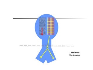1 Estímulo  Ventricular 