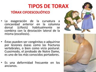 TIPOS DE TORAX
       TÓRAX CIFOESCOLIÓTICO

• La exageración de la curvatura a
  concavidad anterior en la columna
  dorsal (cifosis) habitualmente se
  combina con la desviación lateral de la
  misma (escoliosis).

• Éstas pueden ser congénitas o adquirirse
  por lesiones óseas como las fracturas
  vertebrales, o bien como vicio postural.
  Cuasimodo, el jorobado de Notre Dame,
  es uno de los más conocidos portadores.

• Es una deformidad frecuente en los
  ancianos.
 