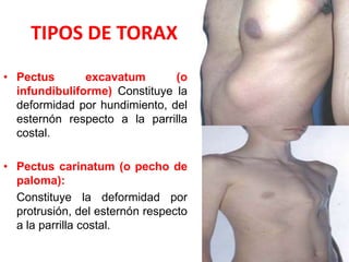 TIPOS DE TORAX
• Pectus       excavatum       (o
  infundibuliforme) Constituye la
  deformidad por hundimiento, del
  esternón respecto a la parrilla
  costal.

• Pectus carinatum (o pecho de
  paloma):
  Constituye la deformidad por
  protrusión, del esternón respecto
  a la parrilla costal.
 