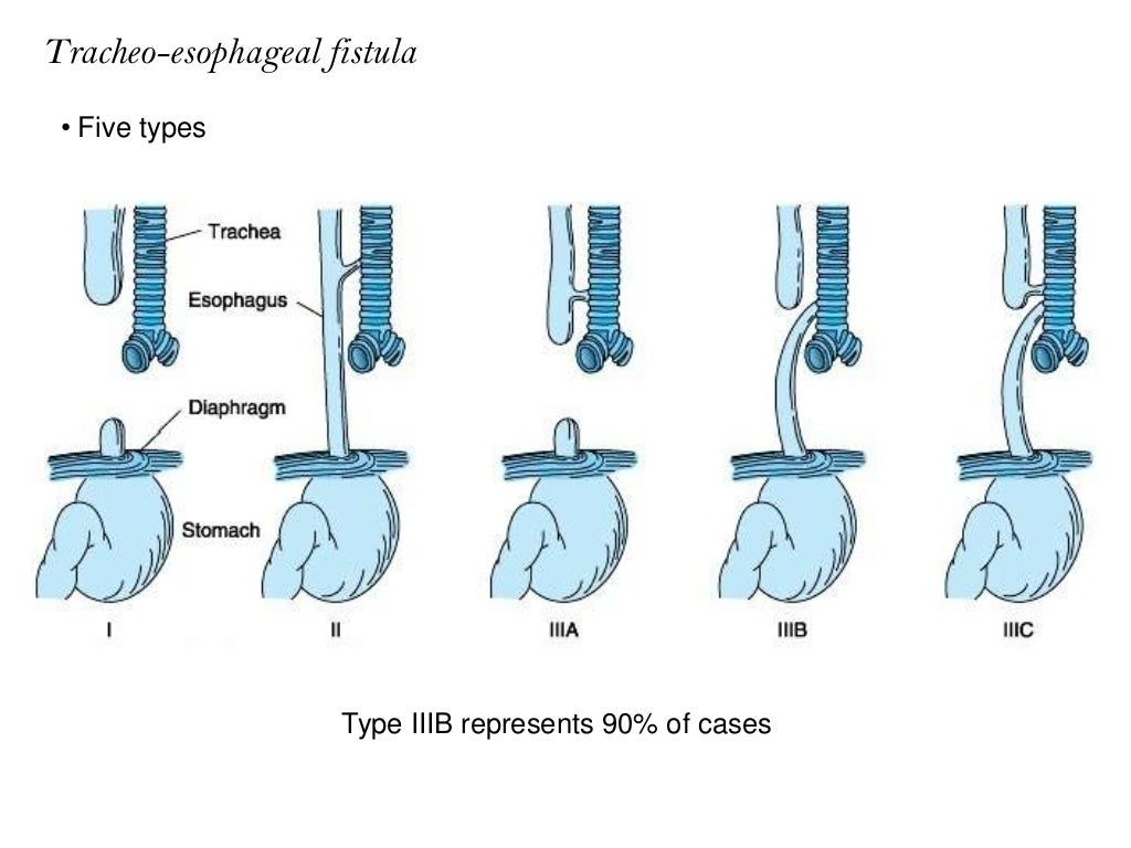 Tracheo Esophageal Fistula and Anesthesia